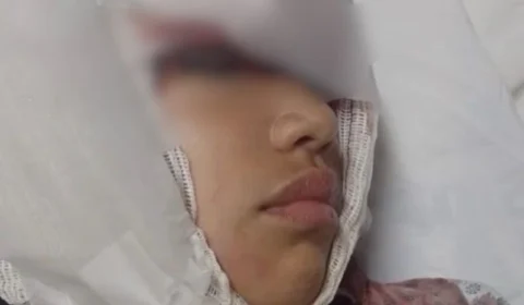 VEJA VÍDEO: menina fica gravemente ferida e perde couro cabeludo em parquinho