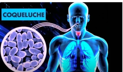 Casos de coqueluche disparam no Brasil e preocupa Ministério da Saúde