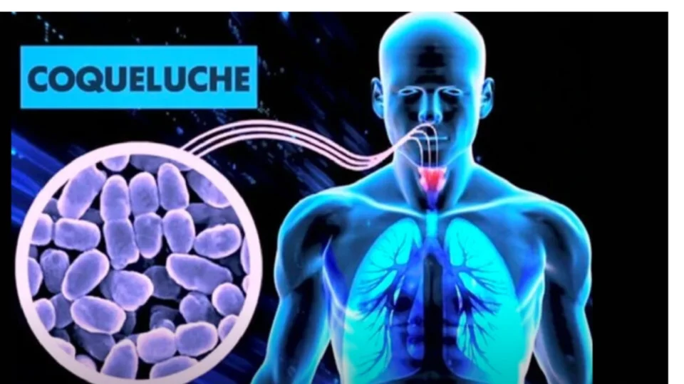 Casos de coqueluche disparam no Brasil e preocupa Ministério da Saúde