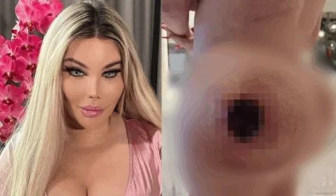 Picada de abelha deixa buraco no bumbum de modelo e gera complicações