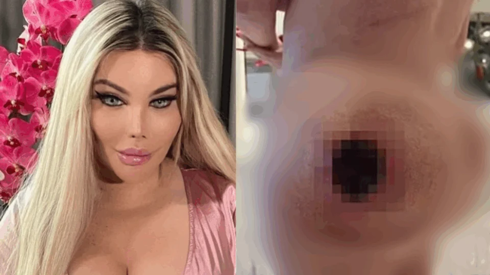 Picada de abelha deixa buraco no bumbum de modelo e gera complicações