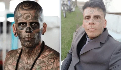 VÍDEO: agora evangélico, homem ‘mais tatuado do Brasil’ passa por remoção dos desenhos