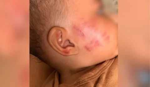 Mãe denuncia creche após bebê de seis meses voltar com marcas de mordida no rosto