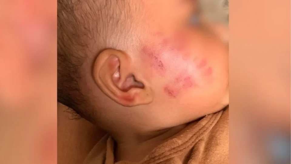 Mãe denuncia creche após bebê de seis meses voltar com marcas de mordida no rosto