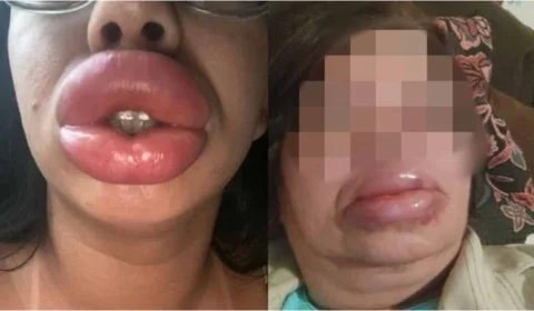 Falsa biomédica é indiciada após deformar bocas de quatro pacientes