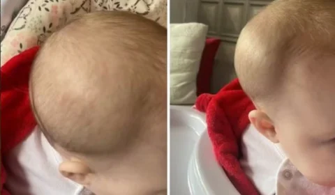 Mãe denuncia creche após filha sofrer fratura no crânio durante adaptação