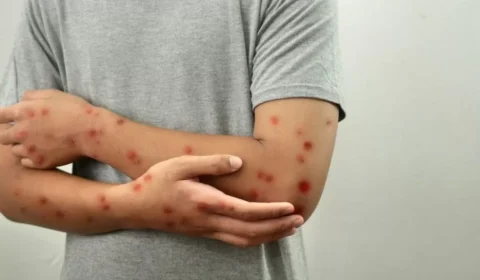 Saúde confirma primeiro caso de nova cepa de Mpox no Brasil