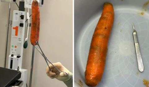 Homem procura emergência após introduzir uma cenoura no canal retal