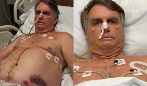 Bolsonaro mostra cicatriz em foto e completa uma semana na UTI após cirurgia de 12h