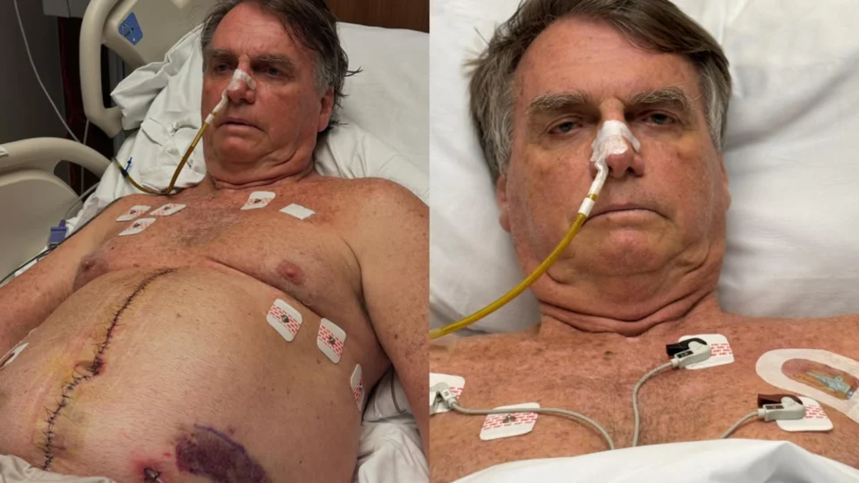 Bolsonaro mostra cicatriz em foto e completa uma semana na UTI após cirurgia de 12h