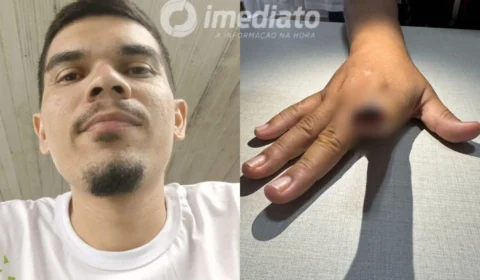 Mulher tem dedo arrancado por mordida do namorado durante ataque de ciúmes em Manaus