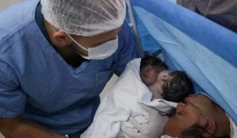 Em parto raro, gêmeas siamesas unidas pelo abdômen nascem em maternidade Ana Braga