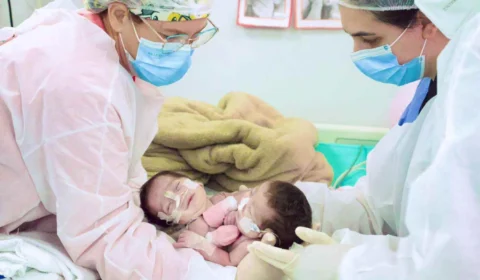 Cirurgia de separação de gêmeas siamesas do Amazonas é bem-sucedida em Goiânia