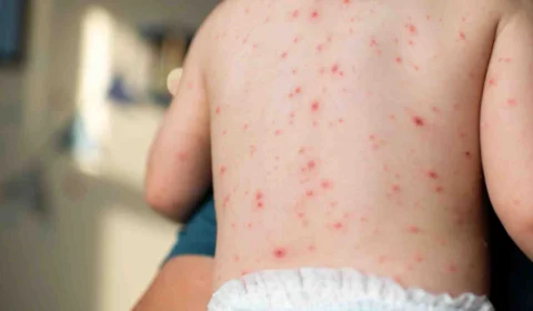 FVS-RCP confirma casos de varicela em escolas de Iranduba, descartando Mpox