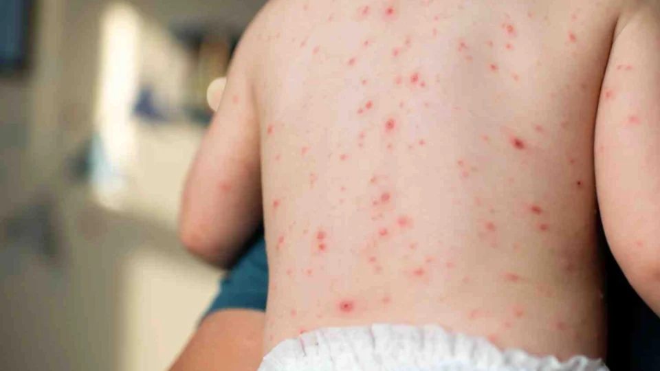 FVS-RCP confirma casos de varicela em escolas de Iranduba, descartando Mpox