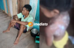IMAGEM FORTE: padrasto é preso após jogar mingau quente em criança no interior do Amazonas