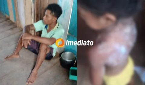 IMAGEM FORTE: padrasto é preso após jogar mingau quente em criança no interior do Amazonas