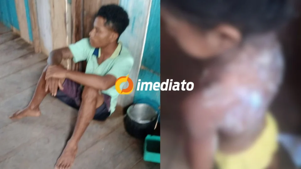 IMAGEM FORTE: padrasto é preso após jogar mingau quente em criança no interior do Amazonas