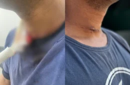Veja o vídeo: linha de cerol quase decepa pescoço de trabalhador que voltava de moto com a filha no São José