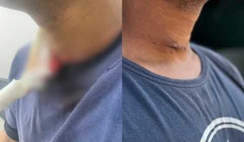 Veja o vídeo: linha de cerol quase decepa pescoço de trabalhador que voltava de moto com a filha no São José