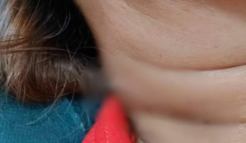 Mulher vai parar em hospital após espinha de peixe atravessar o pescoço na Tailândia