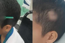 Veja o que aconteceu: Criança fica com lápis cravado na cabeça após briga em escola de São Paulo