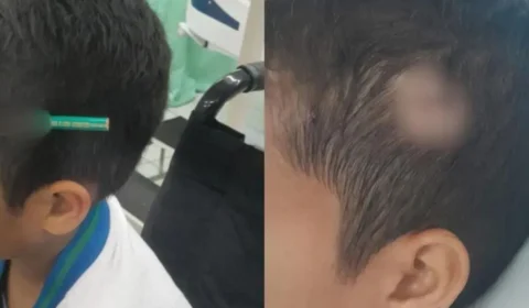 Veja o que aconteceu: Criança fica com lápis cravado na cabeça após briga em escola de São Paulo