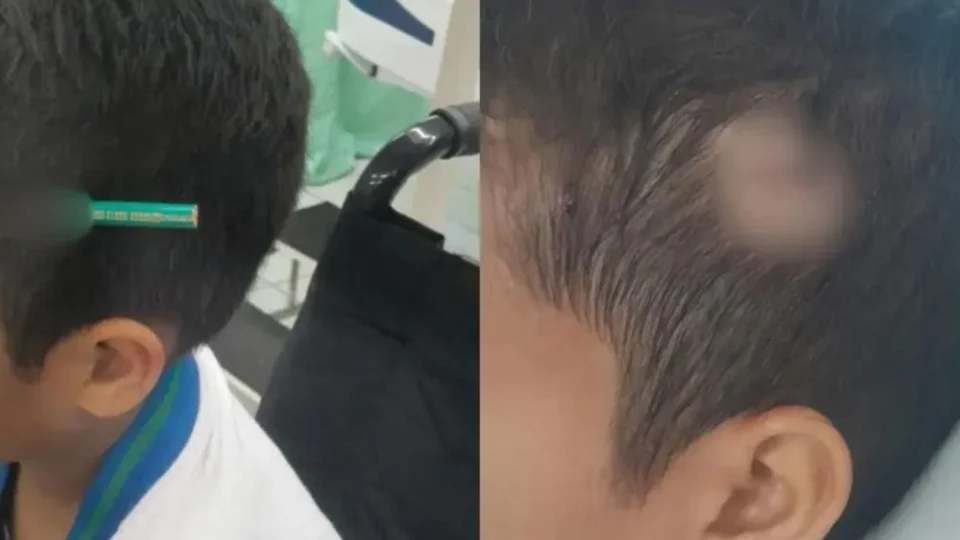 Veja o que aconteceu: Criança fica com lápis cravado na cabeça após briga em escola de São Paulo