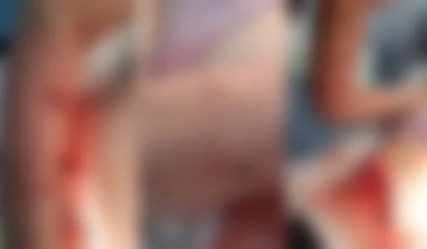 IMAGENS FORTES: Menina de 12 anos leva 62 pontos após ataque de Pit Bull em Chapecó (SC)