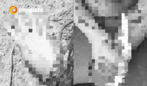 Homem dá entrada em hospital de Maués com mão decepada após possível ataque no garimpo