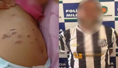 Veja a foto: Padrasto é preso após queimar barriga de bebê de 10 meses com cigarro
