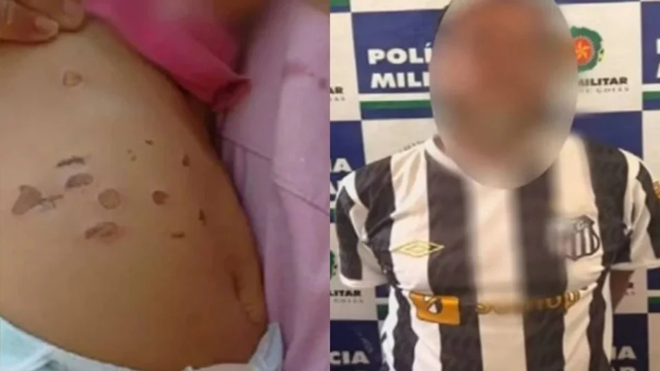Veja a foto: Padrasto é preso após queimar barriga de bebê de 10 meses com cigarro