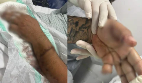 Motorista de aplicativo tem dedo amputado após ataque a terçadadas em Manaus