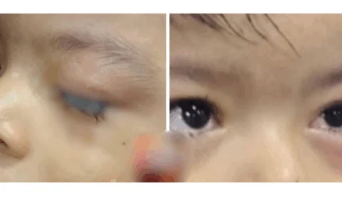 Criança de 2 anos tem olhos colados por cola industrial e mobiliza hospital no AM