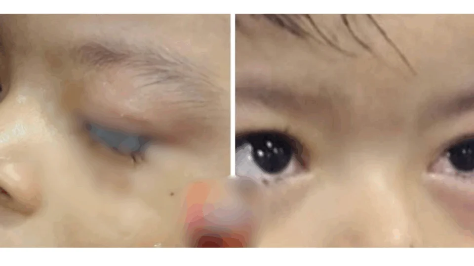 Criança de 2 anos tem olhos colados por cola industrial e mobiliza hospital no AM