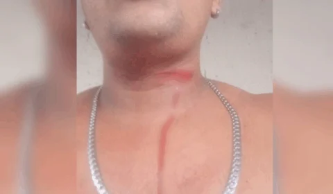 Jovem escapa da morte após ser atingido por linha de papagaio em Manaus