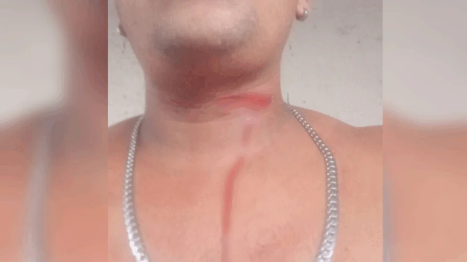 Jovem escapa da morte após ser atingido por linha de papagaio em Manaus