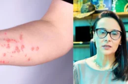 Sesau confirma quatro infecções por Mpox em Porto Velho e dá orientações à população