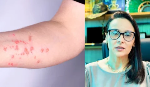 Sesau confirma quatro infecções por Mpox em Porto Velho e dá orientações à população