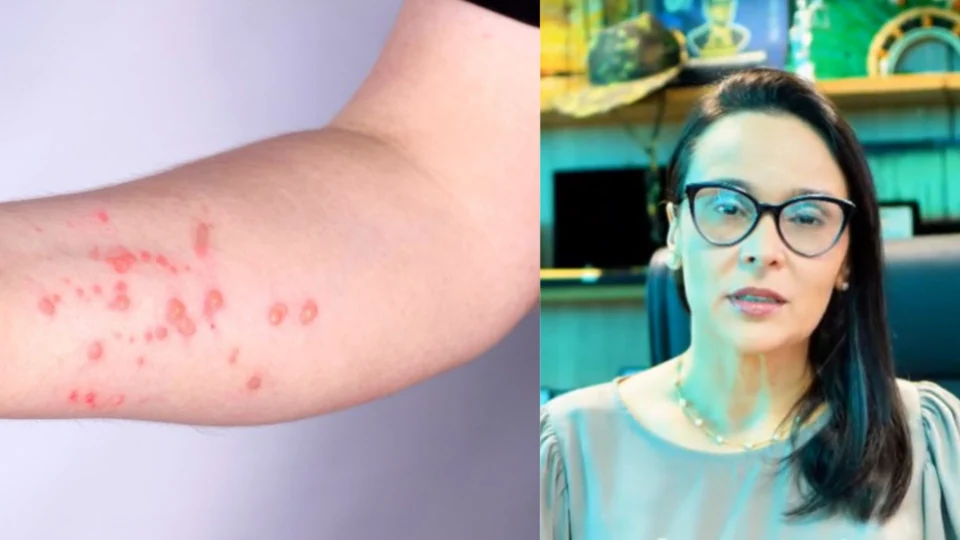 Sesau confirma quatro infecções por Mpox em Porto Velho e dá orientações à população