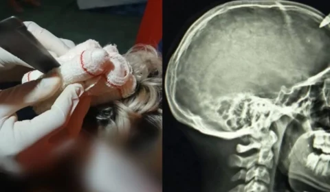 Briga de Irmãos: adolescente fica ferido após faca ficar cravada na cabeça durante discussão em Portel