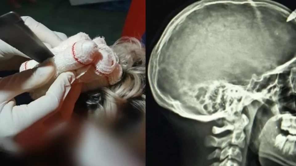 Briga de Irmãos: adolescente fica ferido após faca ficar cravada na cabeça durante discussão em Portel