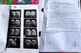 Moradora de Porto Velho espera há mais de 10 anos por cirurgia e denuncia falhas no sistema de saúde