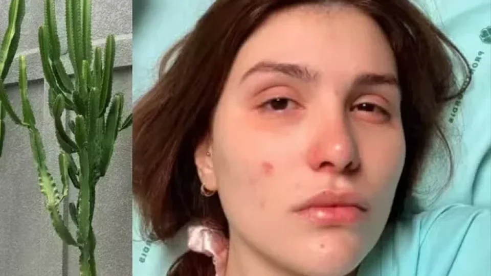 ALERTA: Influenciadora alerta após sofrer queimadura nos olhos com planta popularmente chamada de cacto-candelabro