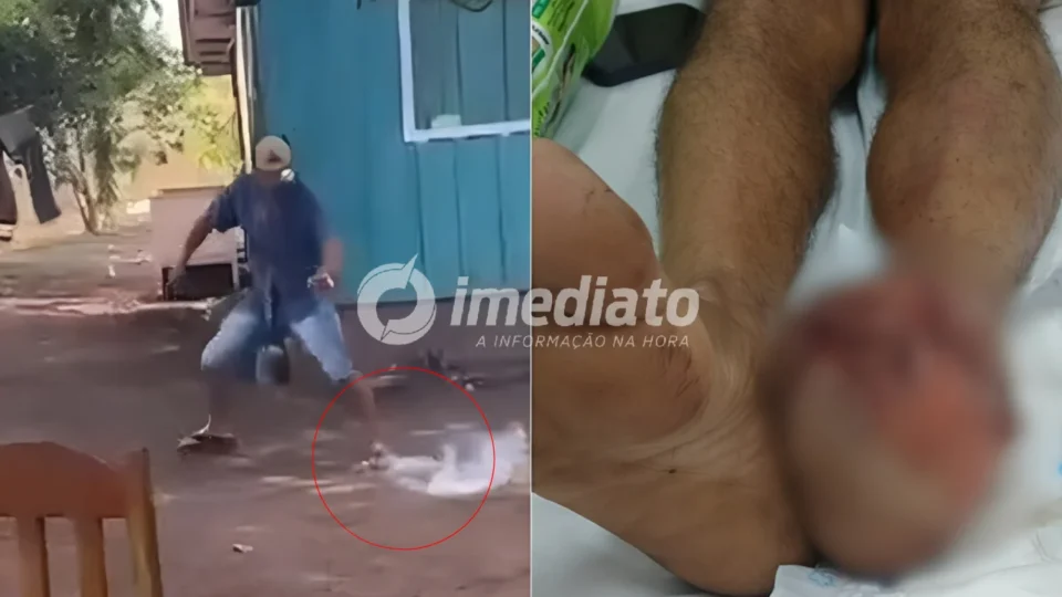 VEJA VÍDEO: Homem perde todos os dedos do pé após tentar conter explosão de ‘catolé’ com pisão