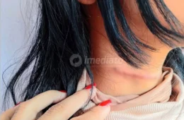IMAGENS FORTES: Adolescente é ferida no pescoço durante tentativa de assalto em frente a escola em Manaus