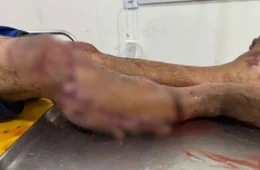 VEJA O VÍDEO | Pescador é atacado por jacaré no Rio Araguaia e resgatado por moradores