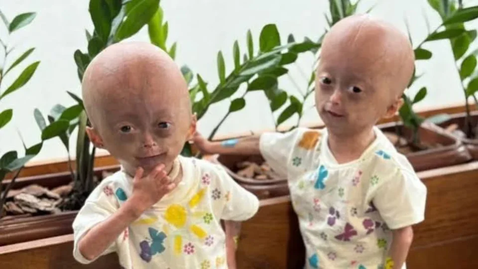 Morre Elis, uma das gêmeas brasileiras diagnosticadas com síndrome rara que causa envelhecimento precoce